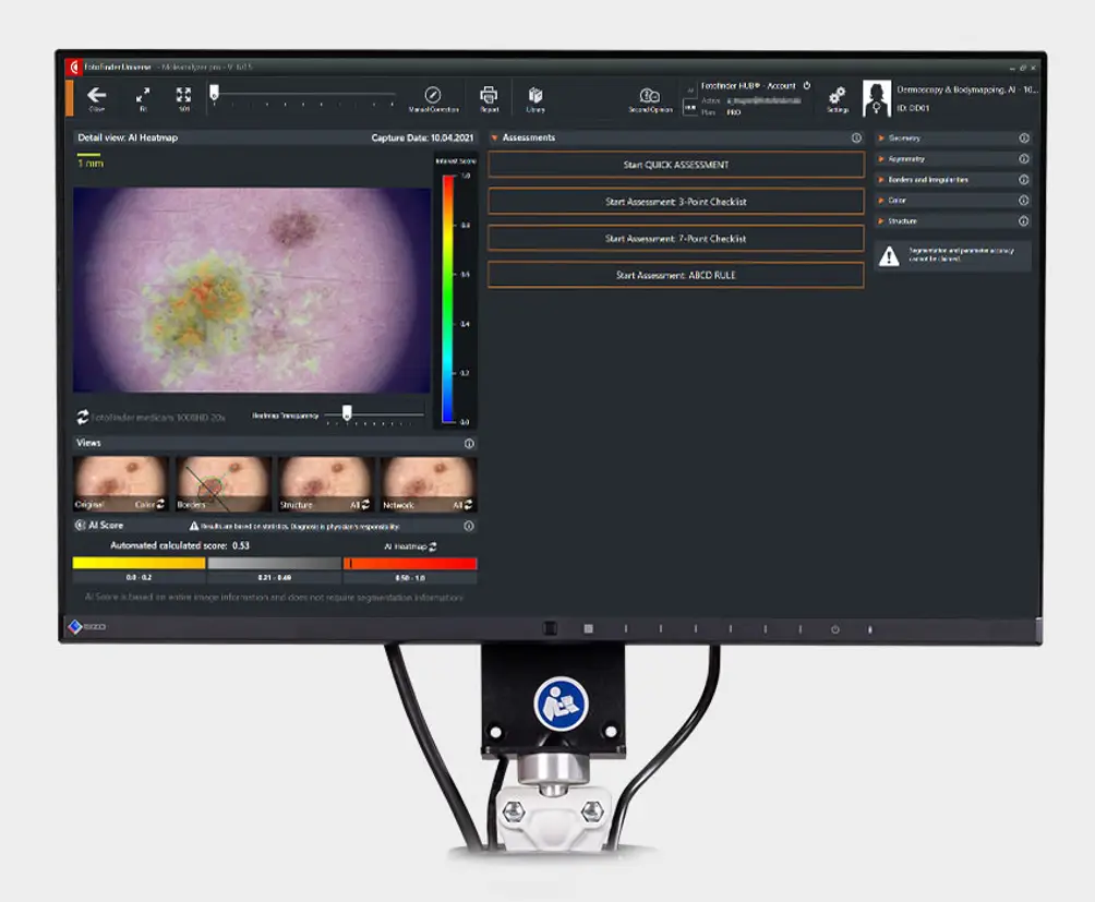 videodermatoscopio Fotofinder