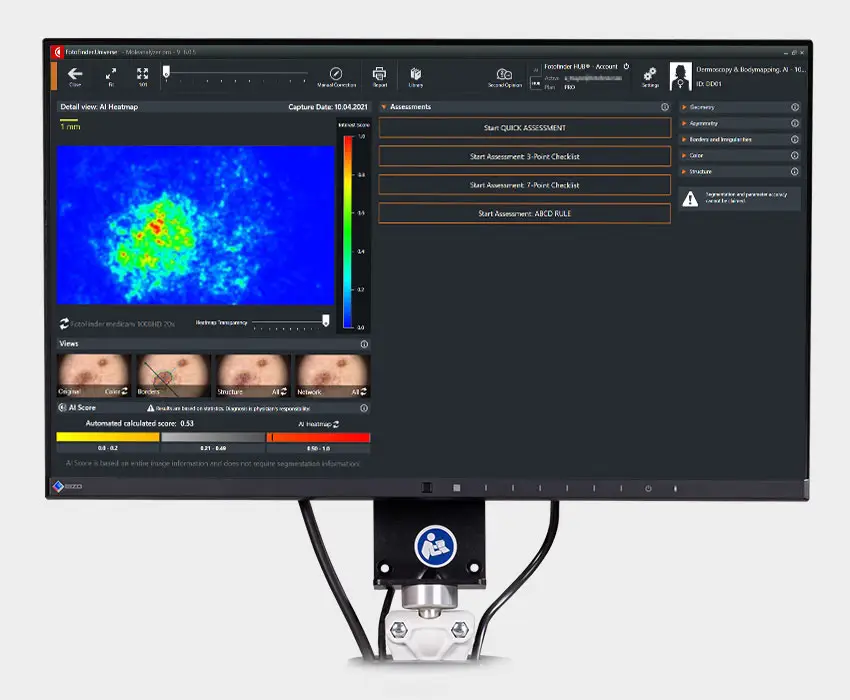 videodermatoscopio Fotofinder Catania