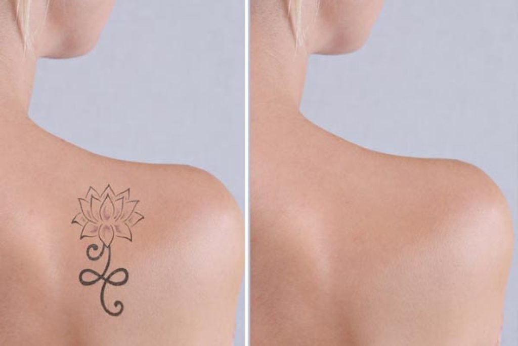 Rimozione tatuaggi laser Catania