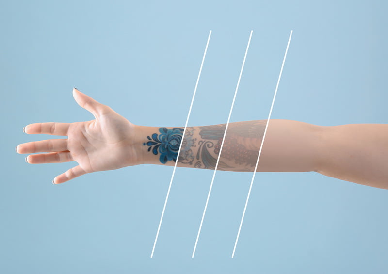 rimozione tatuaggi colorati Catania