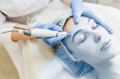 Rimozione capillari con il laser Adrano